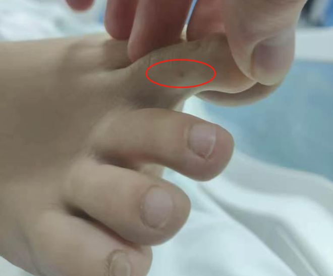 死亡记录：曾诊断为不明生物咬伤(神经毒蛇) 等开元棋牌“三亚旅游被不明物咬伤身亡27岁女子”(图2)